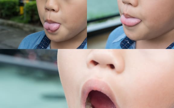 Ankyloglossia or tongue tie.