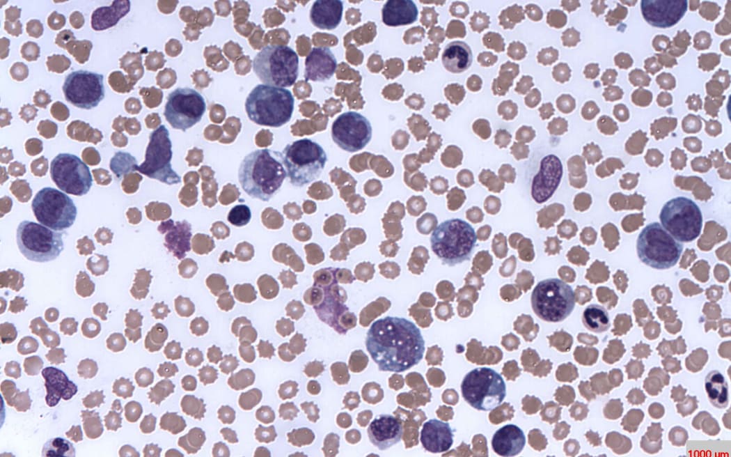 Leukaemia cells