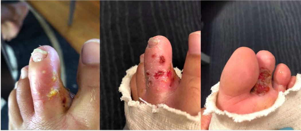 Horouta Waka Hoe club paddlers shared photos of infected toes, which they believed could be attributed to the unhealthy state of the awa.
