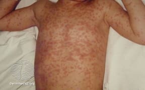 A child with measles