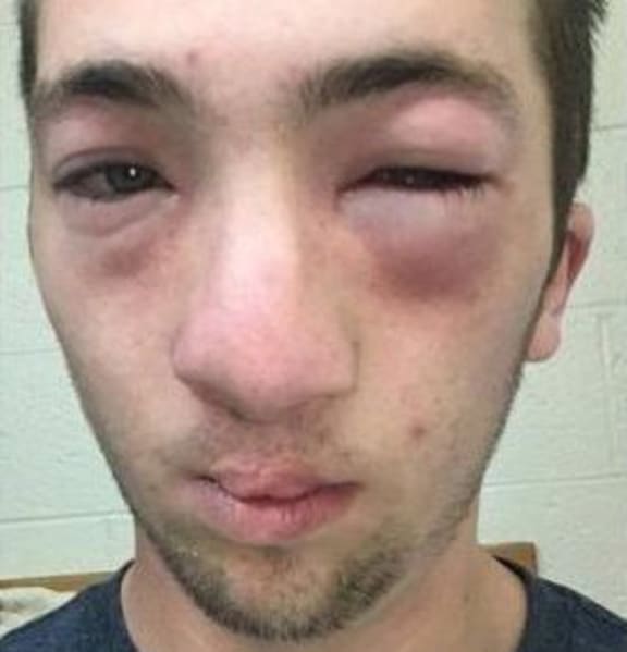 Andrew Seely's face became swollen after peanut butter was allegedly rubbed on his face by another student.