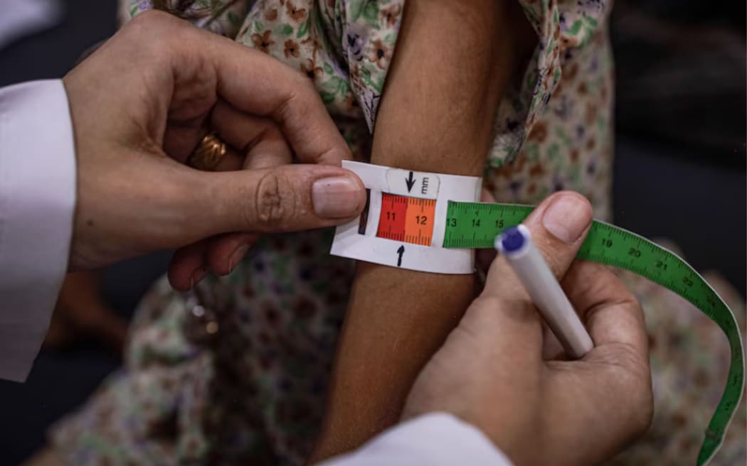 The red part of this tape indicates a child is suffering from acute malnutrition.(ABC News)