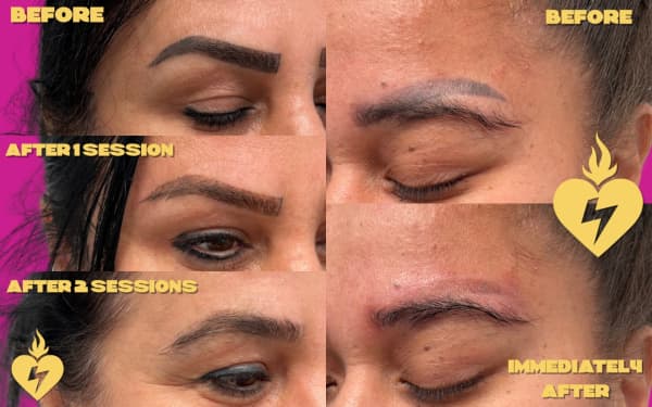 Examples of eyebrow removal from Scared Laser.