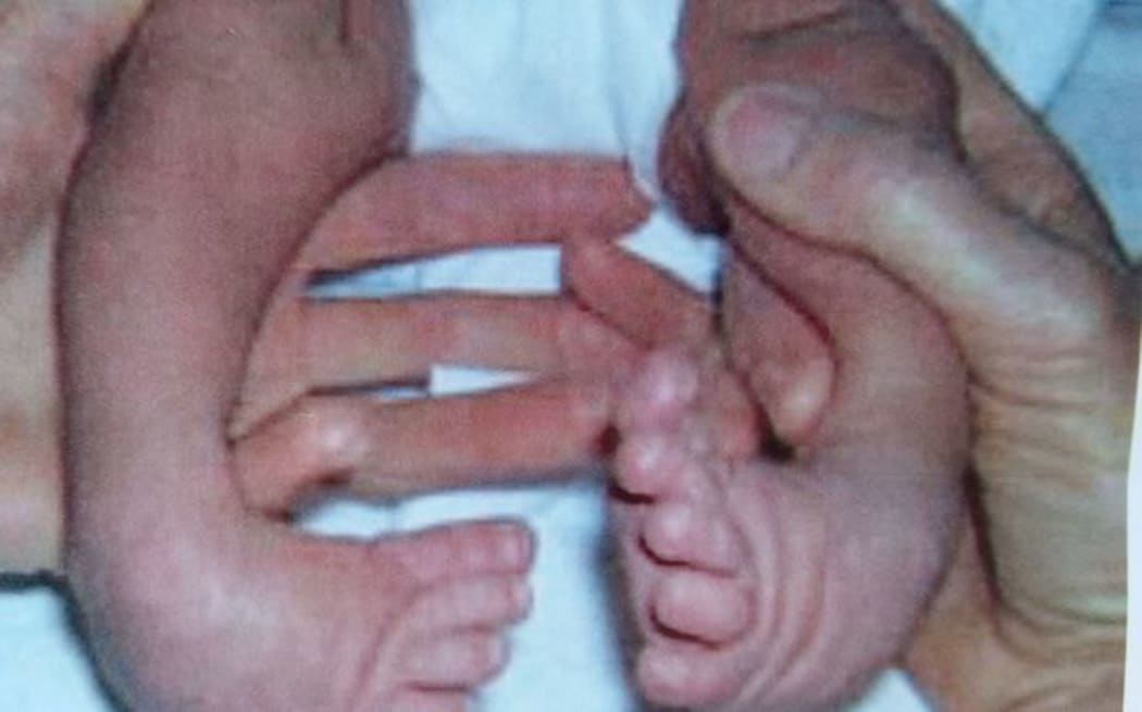 Clubfoot