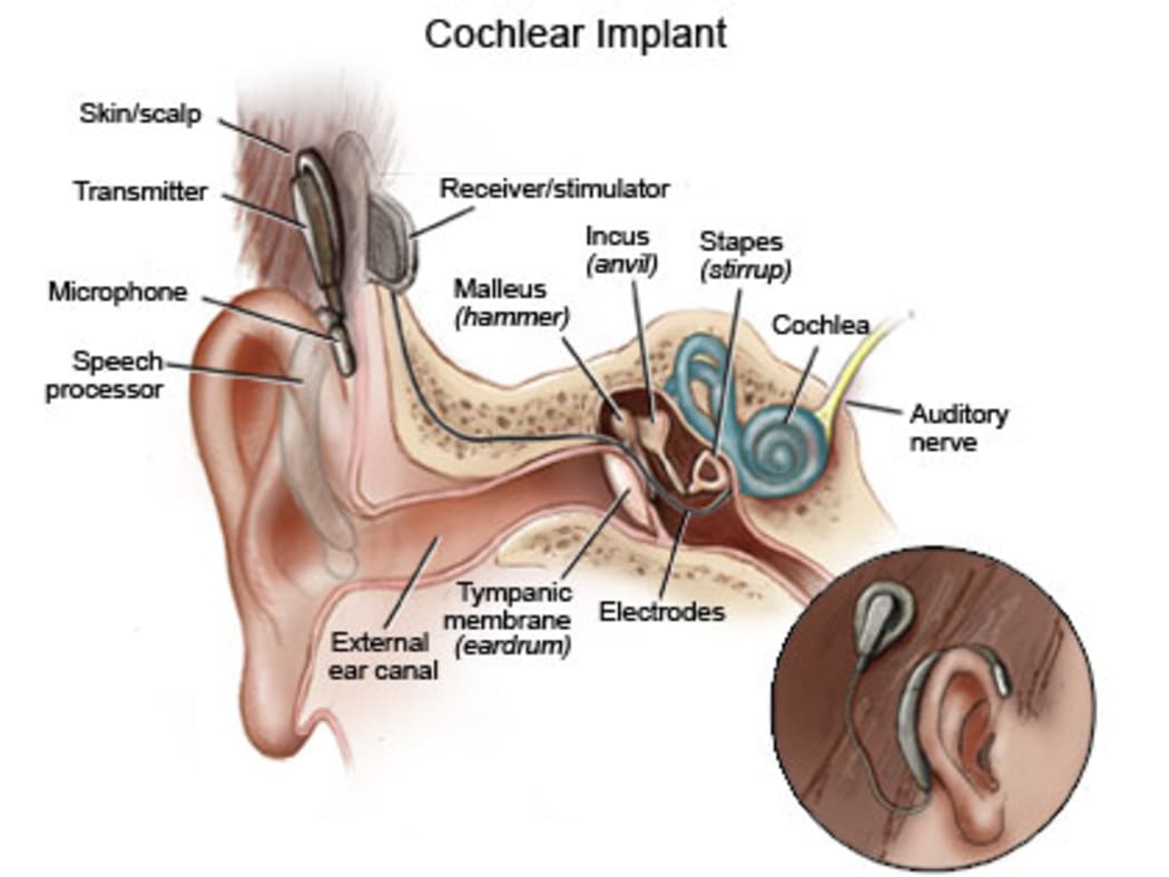 Cochlear Implant