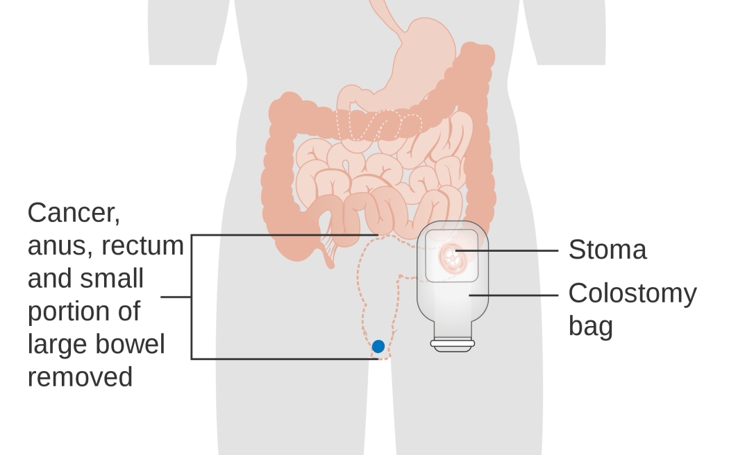 Diagram showing a colostomy with a bag.