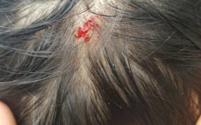 Manus refugee hurt during police assault