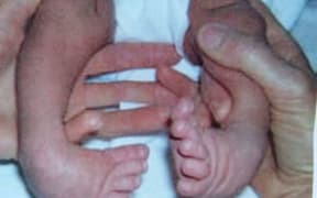 Clubfoot