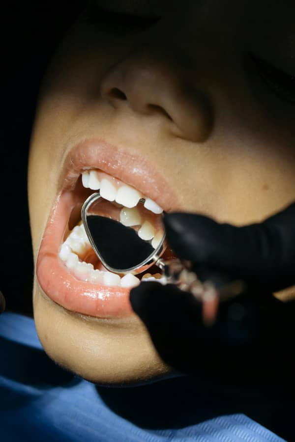 A close-up of a child's mouth with a dentist's mirror inside it.
