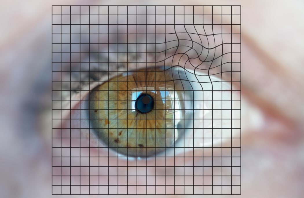 Amsler grid used to detect the Macular Degeneration Related to Age (MDRA). 
 

GARO/PHANIE