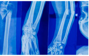 Fractured bone.