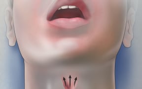 vocal chords illustration