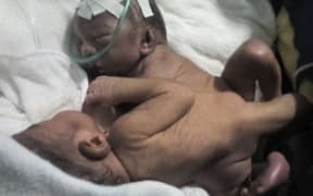 The family is urgently trying to find a way for the twins to be surgically separated. (Supplied)