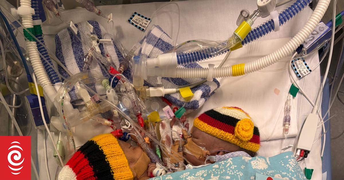 One of Papua New Guinea conjoined twins dies