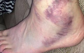 Tyson Fury sprains ankle.