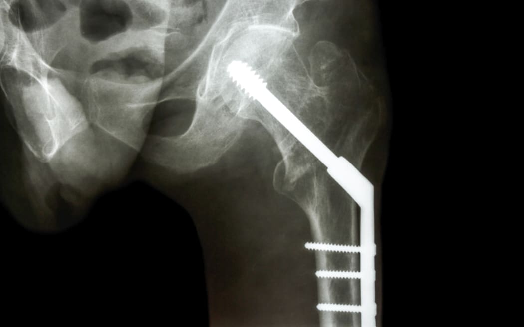 film x-ray left hip : show fracture neck of femur(thigh's bone). patient was operated and fixed bone by screw