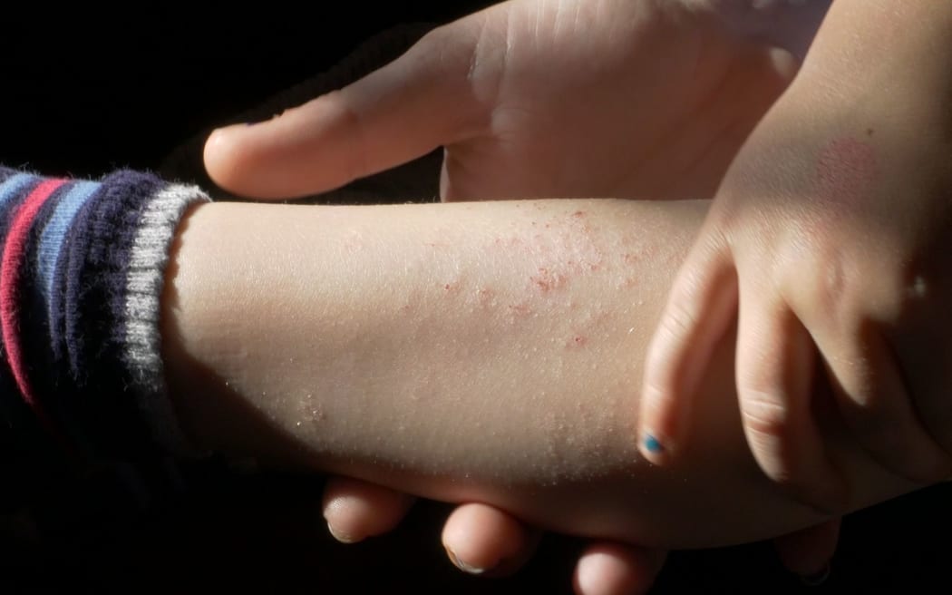 Some of the eczema on Cooper's leg.