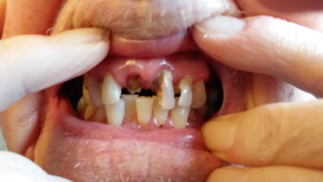 Resthome resident missing front teeth unnoticed by staff