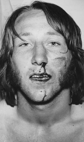 An injured Welsh rugby player, John Peter Rhys (J.P.R.) Williams.
