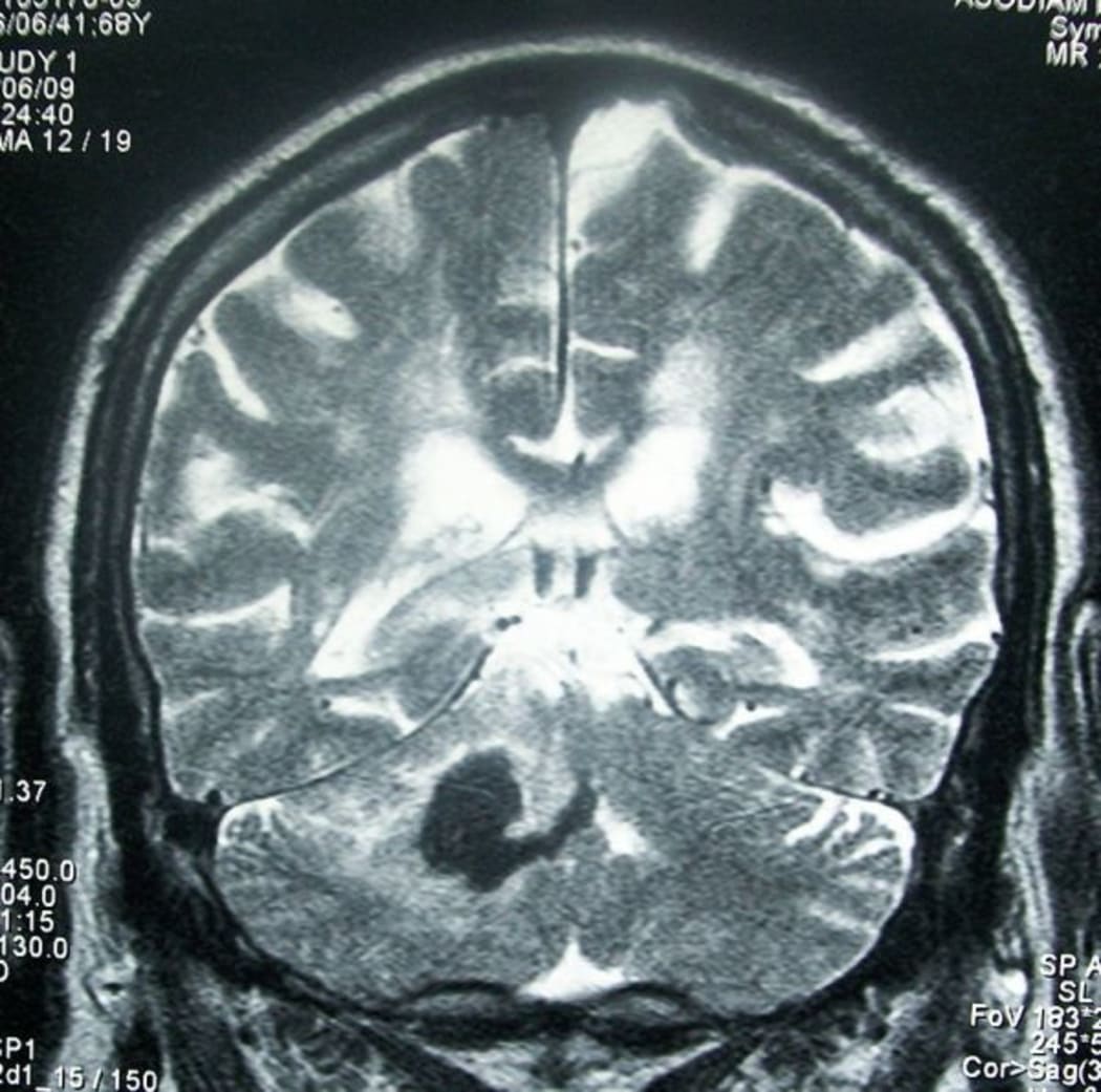 Head MRI showing deep intracerebral hemorrhage (cerebellum)
