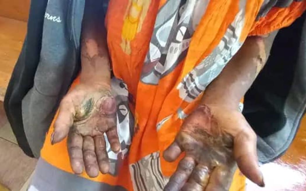Hands of a sorcery related violence survivor.