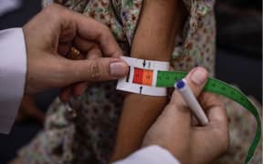The red part of this tape indicates a child is suffering from acute malnutrition.(ABC News)
