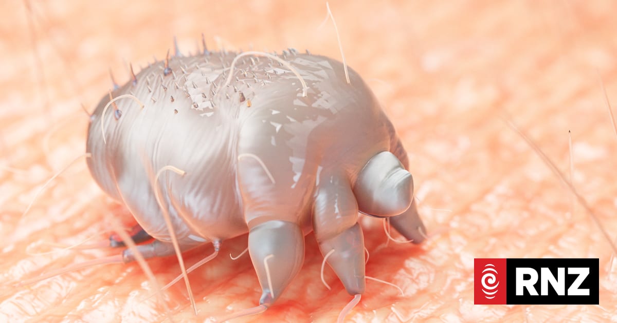 Whanganui scabies outbreak a real head scratcher