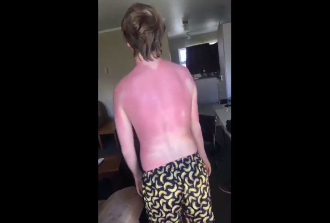 Te Kuiti resident Margaret says her son has spent a week and a half in agony after being sunburnt despite using sunscreen.