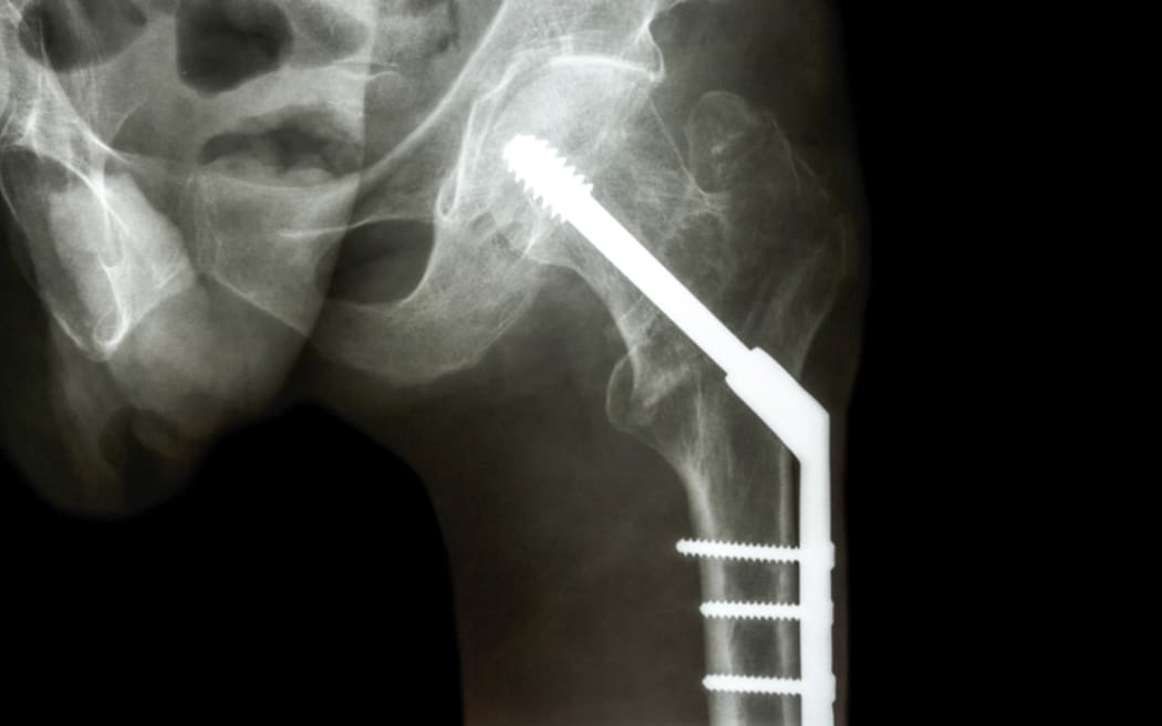 film x-ray left hip : show fracture neck of femur(thigh's bone). patient was operated and fixed bone by screw