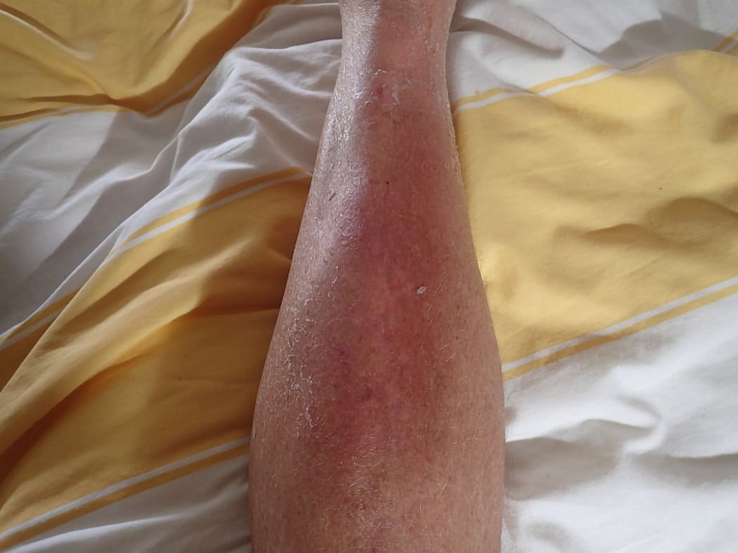 A close-up of Bruce's shin, two week after contracting Cellulitis. The skin is inflamed and peeling but feels bettter.