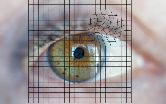 Amsler grid used to detect the Macular Degeneration Related to Age (MDRA). 
 

GARO/PHANIE