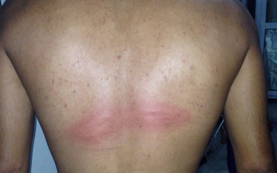 A refugee who claims he was struck across the back with a bat by a masked assailant on a motorbike.