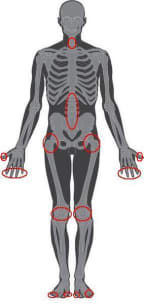 Skeleton showing how osteoarthritis can occur in a number of joints. Mobility can be impaired when it occurs in the hips, knees and ankles.